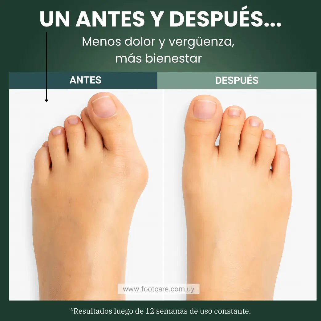 KIT ANTI-BUNION ORTOPÉDICO